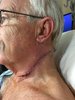 post op melanoma.jpg