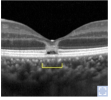 solar retinal damage.png solar retinal damage.png